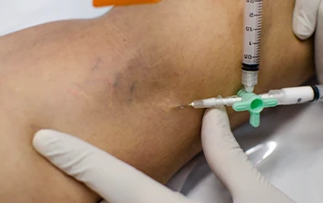 Imagem representativa: Escleroterapia de Varizes com Espuma