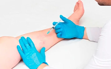 Imagem representativa: Escleroterapia de Varizes com Solução Hipertônica